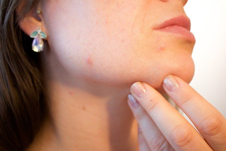 lutter-contre-acne-visage