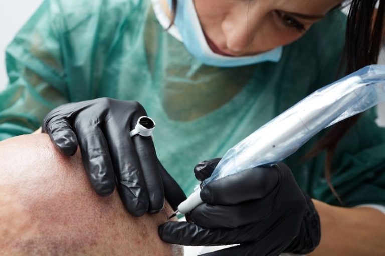 Micropigmentation du cuir chevelu : la technique de tricopigmentation